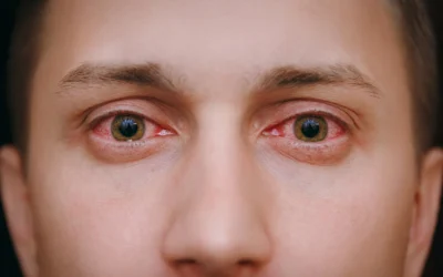 Pink Eye: Symptoms, Causes, & Treatment