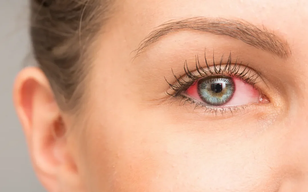 What Causes Bloodshot Eyes? 